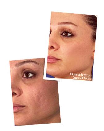 Revitol Scar Cream pentru a scapa de cicatricile inestetice